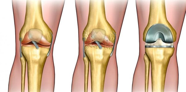 Ендопротезування колінного суглоба